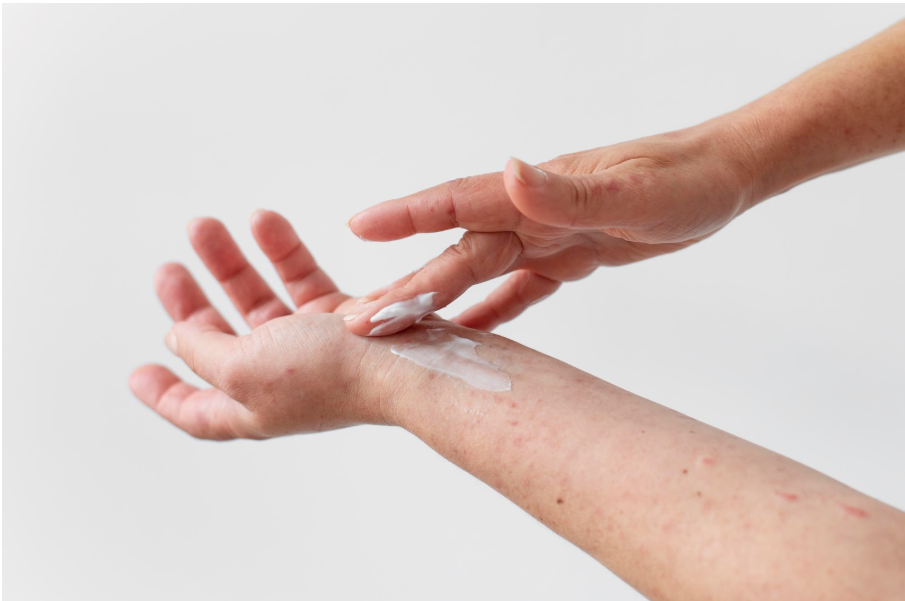 Човек маже ръцете си със специален крем при алергичен обрив от храна
