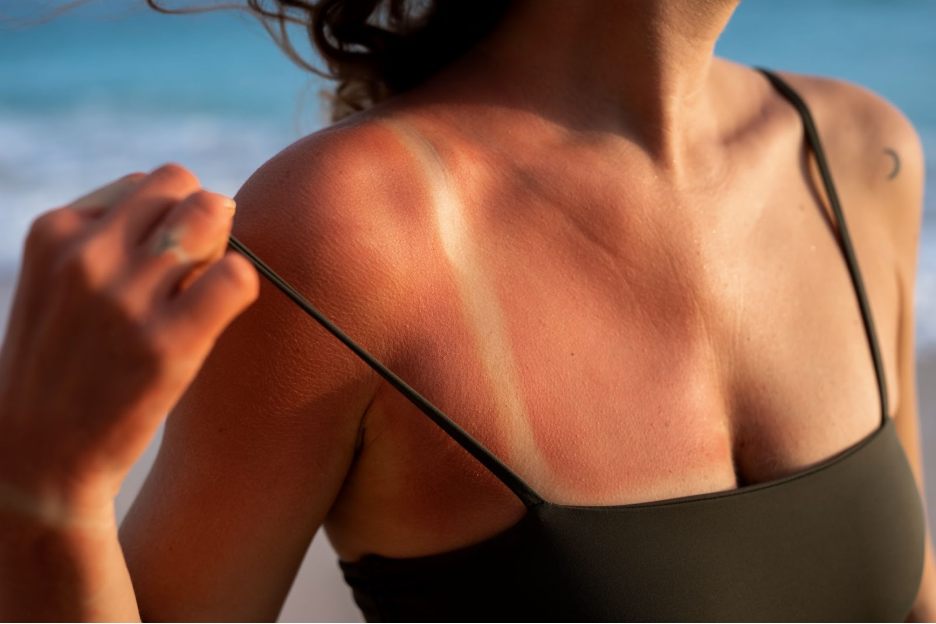 Жена със слънчево изгаряне на раменете